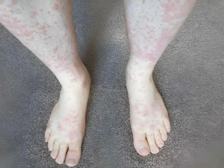 Mottling Before Death and Mottled skin treatment in Cypress